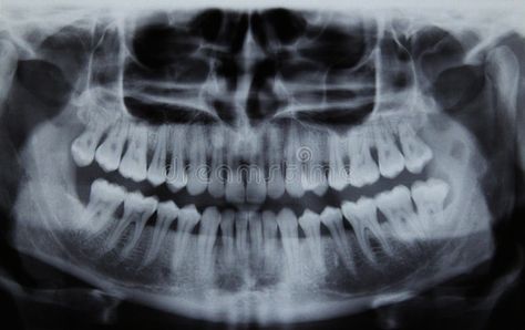 Panoramic dental Xray. Full mouth panoramic dental X-ray of a 29 year old male. , #AFFILIATE, #mouth, #panoramic, #ray, #Full, #Panoramic #ad Dental Panoramic X Rays, Dental Xrays, Candela Obscura, Dental Animation, Dental Images, Xray Art, Panorama Photography, Medical Animation, Dental Anatomy