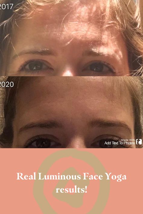 Before and after pics showing reduced forehead lines Face Yoga Before And After, Yoga Results, Smokers Lines, Forehead Lines, Face Fitness, Frown Lines, Marionette Lines, Before And After Pics, Turkey Neck