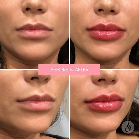 🌟 Fresh Lips Friday 🌟 Check out this stunning transformation! Our amazing patient wanted fuller, symmetrical lips, and we addressed the asymmetry and discoloration with 1 syringe of Restylane Kysse. The results speak for themselves! 🙌💋 A huge shoutout to Staci Courtois for her expert touch and creating these beautifully balanced lips! #FreshLipsFriday #LipFiller #RestylaneKysse #BeforeAndAfter #LipGoals #LipInjections Lip Injections, Lip Fillers, Shout Out, Lips, Beauty, Quick Saves