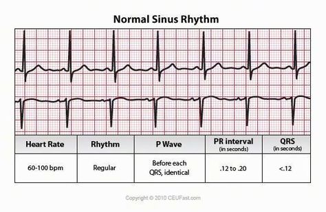 ECG - Normal Sinus Rhythm Cardiac Anatomy, Sinus Rhythm, Normal Sinus Rhythm, Cardiac Cycle, Ecg Interpretation, Nursing Fun, Nclex Review, Med Surg Nursing, Heart Rhythm