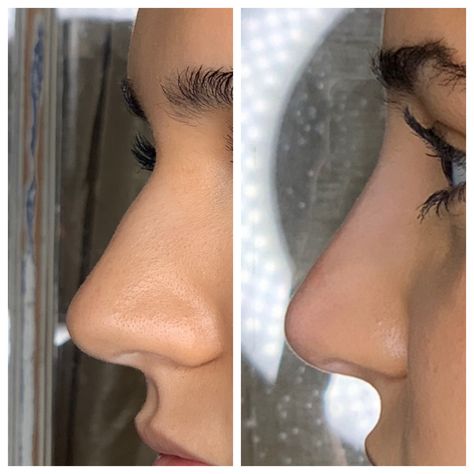 Straight Nose With Bump, Straight Nose Front View, Straight Nose Side Profile, Rhinoplasty Inspiration, Nose Filler, Smooth Nose, Nose Fillers, Straight Nose, Pretty Nose