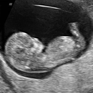 Fetal Size: Length, 1.61 inches; weight, 0.25 ounces. Fetal Development Milestones: Chin and neck are developing. Facial features are becoming more defined. Baby's ears move higher on the head. What You're Seeing: Baby-to-be is lying on her back with her head on the left side of the image and her legs pointing up. From this image, you can see that her neck is growing, separating her large head from the rest of her body. Her head still makes up more than 50% of 11 Week Ultrasound, 16 Weeks Pregnant Ultrasound, Baby Ultrasound Pictures, 11 Weeks Pregnant, 15 Weeks Pregnant, Trimester By Weeks, Sonogram Pictures, Pregnancy Ultrasound, First Ultrasound