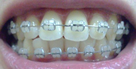 Silver pearly bands Silver Braces, Lingual Braces, Ceramic Braces, Cute Braces Colors, Adult Braces, Cute Braces, Brace Face, Braces Colors, Teeth Bleaching