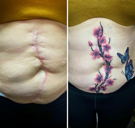 This Is A 40-Year-Old Scar And We Covered It With Some Cherry Blossoms And Butterflies C Section Tattoo, Birthmark Tattoo, Scar Cover Up, Mark Tattoo, Body Positivity Art, Scar Tattoo, Old Tattoos, 3d Tattoo, Hand Tattoos For Guys