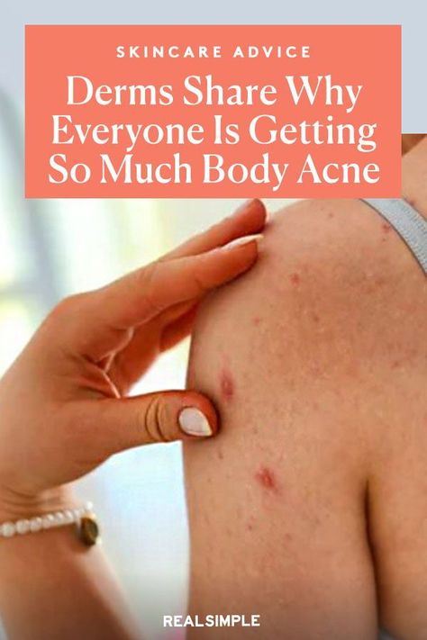 Arm Acne, Body Acne Remedies, Acne Reasons, Back Acne Remedies, Acne Body Wash, Chest Acne, Blind Pimple, Forehead Acne, Pimples Under The Skin