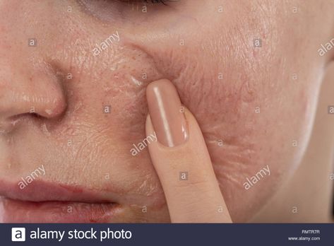 female face with burned skin after chemical peeling Stock Photo - Alamy Chemical Burn On Face, Chemical Peeling, Chemical Burn, Female Face, Chemical Peel, Woman Face, Logo Design, Resolution, Stock Photos