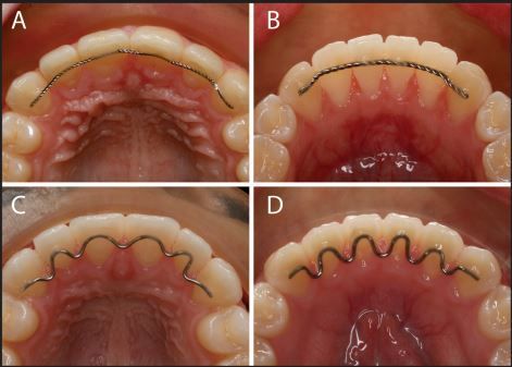 What is a permanent retainer? A fixed retainer, also known as a permanent or bonded retainer, is a wire that is glued to the lingual (tongue side) of the teeth. Contact to best orthodontist for Bonded Retainer or Replacement Retainer. Black Hair Quick Weave, Permanent Retainer, Future Dentist, Dental Hygiene Student, Orthodontic Appliances, Dental Videos, Dental Hygiene School, Brace Face, Dental Technician