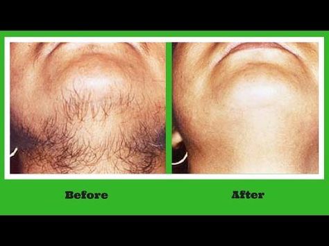 How to get rid of facial hair Naturally Permanently at home,Remove Facial hair Naturally at Home - YouTube Permanent Hair Removal At Home, Natural Hair Removal Remedies, Hair Removal At Home, Chin Hair, Unwanted Hair Permanently, Natural Hair Removal, Permanent Hair Removal, Underarm Hair Removal, Hair Care Regimen