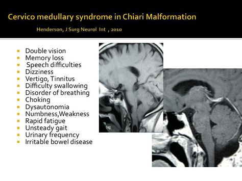 Cervical Facet Syndrome, Cranial Cervical Instability, Cervical Instability, Foraminal Stenosis Cervical, Cervical Traction Device, Cervical Spine Xray, Irritable Bowel Disease, Chiari Malformation, Irritable Bowel