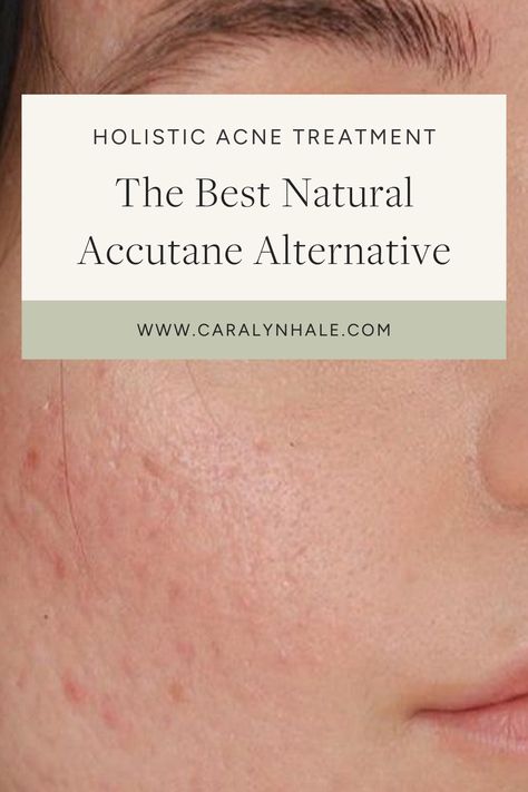 Doxycycline For Acne Before And After, Skin Theory, Accutane Before And After, Comedonal Acne, Mild Acne, Hormonal Breakouts, Holistic Practitioner, Acne Tips, Acne Help