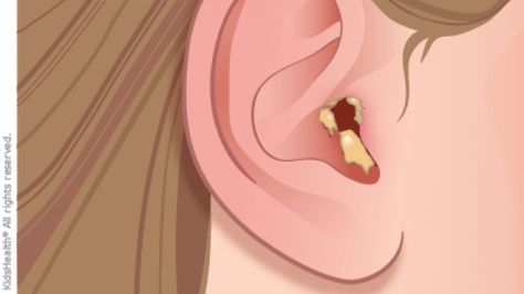 Home Remedies For Swimmers Ear, Swimmers Ear Remedy Kids, Ear Pain Remedies, Swimmers Ear Remedy, Swim Ear, Ear Tubes, Swimmers Ear, Outer Ear, Middle Ear