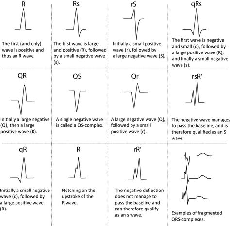 ECG interpretation: Characteristics of the normal ECG (P-wave, QRS complex, ST segment, T-wave) – ECG learning Nursing Cardiac, Normal Ecg, Ekg Rhythms, Cardiology Nursing, Ekg Interpretation, Ecg Interpretation, Paramedic School, Medical Notes, Medical Mnemonics