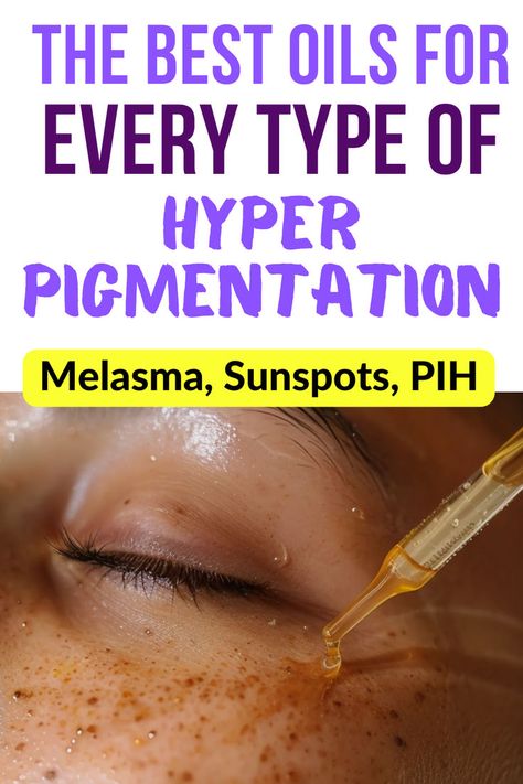 Woman being treated for hyperpigmentation with oil. Text reads: The best oils for every type of hyperpigmentation. Melasma, sunspots, PIH. Scientifically proven. Clearing Dark Spots, Pigmentation Remedy, Home Remedies For Face, Removing Hyperpigmentation, Age Spots On Face, Skin Care Home Remedies, Dark Spots On Face, Dry Skin Remedies, Dry Skin Body