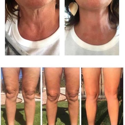 Check Out These Results! This Is The Best Cellulite Cream On The Market! Can Also Be Used On Neck To Rid “Turkey Neck” Retail For $69 This Listing Is For 2. I Have Several Tubes In Stock. Bundle For Discount! Happy Poshing Turkey Neck, Beauty Remedies, Skin Care Kit, Facial Moisturizers, Moisturizer With Spf, Tan Skin, Wrinkle Remover, Skin Care Moisturizer, Skin Cream