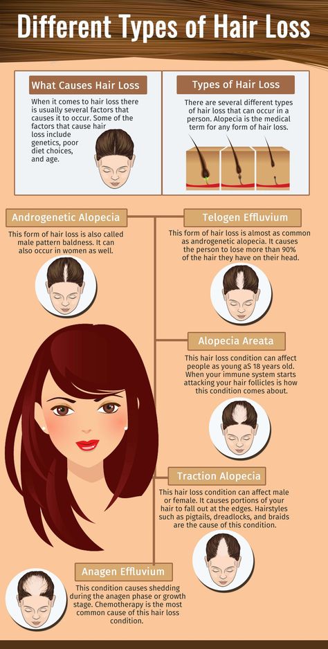 Hair Transplant Women, Baldness Solutions, Regrow Hair Naturally, Hair Transplant Procedure, Androgenetic Alopecia, Fue Hair Transplant, Types Of Hair, Regrow Hair, Lost Hair