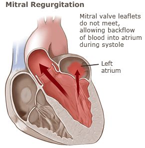 Mitral Valve With Regurgitation Mitral Regurgitation, Mitral Valve Regurgitation, Aortic Valve Replacement, Cardiac Sonography, Vascular Ultrasound, Heart Surgeon, Mitral Valve, Heart Valves, Diagnostic Medical Sonography