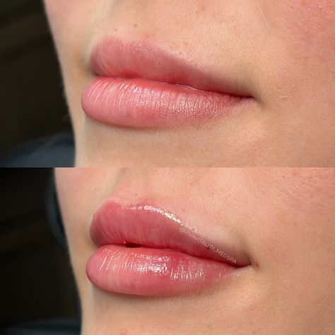 HUBBA HUBBA 🤩 👄 This patient has gotten 3 syringes of restylane Kysse over the course of almost 2 years. She has achieved a gorgeous, natural plump! Can someone please pick our jaw up off the floor?! 😱 Book the appointment, we dare you 😘💕 - - - - 📞 863-450-4060 Or book online at your convenience 💥 - - - Restylane Kysse, lip filler, lippies, lakeland medspa, injector, Florida, natural lips, before and after #medspalife #medspa #lakelandmedspa #lipfiller #lippies #naturallips #lakelandfl #... Lip Filler Before And After, Hubba Hubba, Kissable Lips, Lip Fillers, Med Spa, Natural Lips, Lips, Instagram