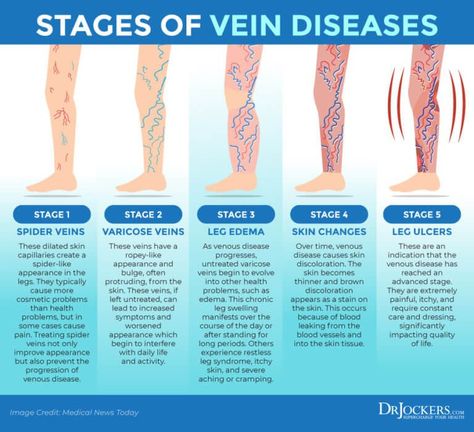 Varicose Veins Causes, Vein Health, Leg Ulcers, Leg Veins, Vein Thrombosis, Venous Insufficiency, Nerve Pain Relief, Chronic Inflammation, Nerve Pain