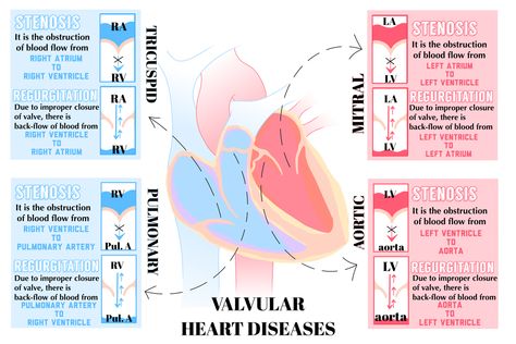 Aortic Regurgitation, Pulmonary Stenosis, Mitral Regurgitation, Mitral Stenosis, Cath Lab Nursing, Cardiac Sonography, Med Surg Nursing, Mitral Valve, Nursing School Essential