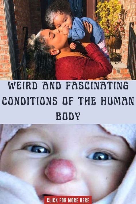 Weird and Fascinating Conditions of the Human Body Kueez Pins, Body Condition, Human Condition, The Human Body, Viral Trend, Skin Conditions, Study Motivation, Viral Pins, How To Look Pretty