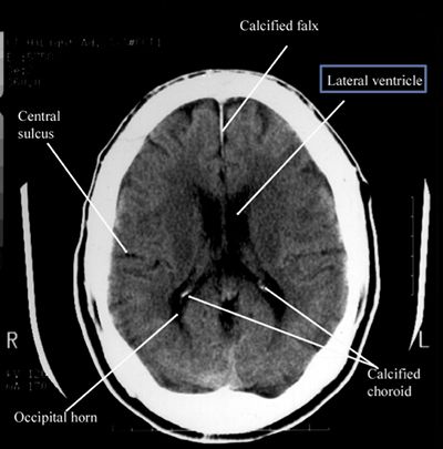 How To Read Mri Scans, Cat Scan Technologist, Ct Brain Anatomy, Ct Scan Brain Anatomy, Ct Head Anatomy, Radiation Technologist, Ct Anatomy, Medical Radiation Technologist, Brain Mri