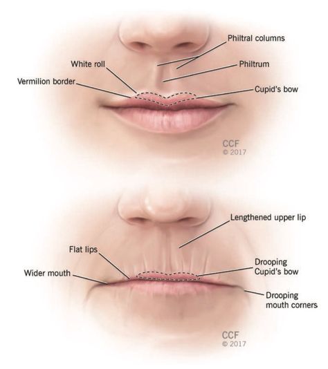 Lip Filler Injection: Needle VS Micro-cannula? Happy Facial Expressions, Lip Filler Injection, Injection Needle, Filler Injection, Aesthetic Training, 2021 Aesthetic, Hyaluronic Acid Fillers, Tear Trough, Facial Contouring