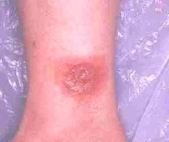 brown-recluse-spider-bite Brown Recluse Spider Bite Pictures, Brown Recluse Spider Bite Stages, Spider Bites Pictures, Recluse Spider Bite, Brown Recluse Spider Bite, Spider Bite, Brown Recluse Spider, Recluse Spider, Brown Recluse