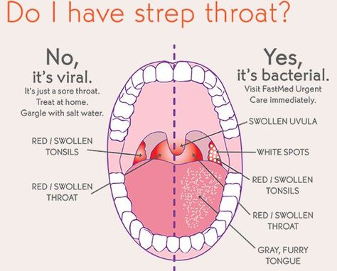 Strep throat is a bacterial infection that causes inflammation and pain in the throat. This common condition is caused by group A streptoco... Strep Throat Symptoms, Strep Throat Remedies, Swollen Tonsils, School Nurse Office, Throat Remedies, Sore Throat Remedies, Throat Infection, Sick Remedies, Strep Throat