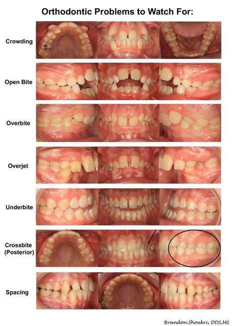 Braces care Dental Assistant Study Guide, Dental Terminology, Braces Care, Dental Hygienist School, Dental Assistant Study, Dental Hygiene Student, Dental Videos, Kesehatan Gigi, Kedokteran Gigi