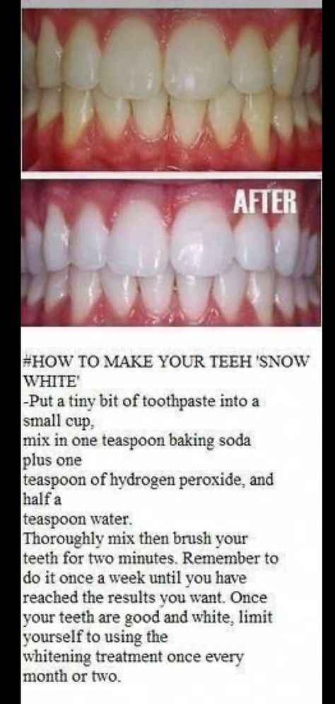 Make Teeth Whiter, Baking Soda Teeth, Natural Teeth Whitening Diy, Obličejové Masky, Baking Soda Teeth Whitening, Nyttige Tips, Teeth Whitening Homemade, Baking Soda And Lemon, Teeth Whitening Remedies