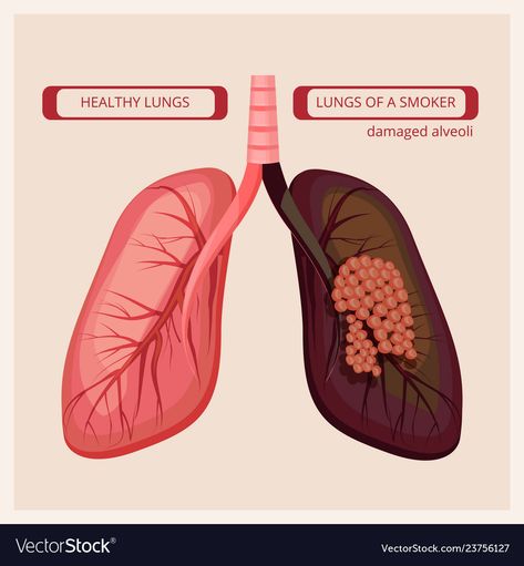 Infographic Booklet, Smokers Lungs, Medical Infographic, Natural Decongestant, Chronic Cough, Healthy Lungs, Types Of Cancers, Abdominal Pain, For You