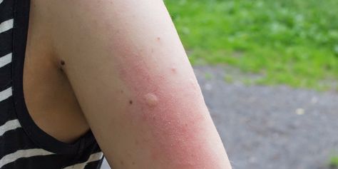 Signs a bug bite is serious - Business Insider Poisonous Insects, Olive Oil Uses, Bug Bite, Swollen Eyes, Tick Bite, Anaphylactic Shock, Fire Ants, Insecticidal Soap, Dawn Dish Soap