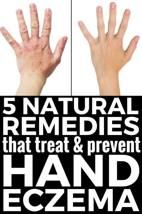 5 Natural Hand Eczema Remedies that Work! There are different types of hand eczema, and the causes can vary from person to person, but on thing is certain: itchy, red, raw, weeping, and dry skin can be pretty miseral. Check out our best tips and natural products that help treat and prevent hand eczema in the winter and beyond and say YES to beautiful skin! #eczema #psoriasis #itchy #skin #dermatitis #remedies #naturalremedies #handeczema Skin Peel, Skincare Solutions, Skin Cream Anti Aging, Cleansing Mask, Charcoal Mask, Mask Diy, Acne Remedies, Skin Remedies, Skin Toner