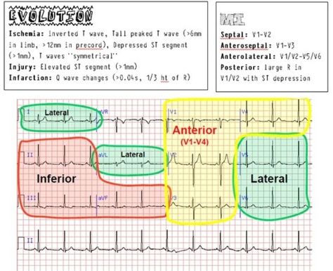 EKG/ECG Cheat Sheet Ekg Interpretation, Np School, Paramedic School, Doctor Medicine, Nursing Information, Nursing Cheat, Pa School, Cardiac Nursing, Critical Care Nursing