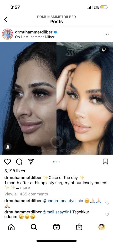 Noise Job Perfect Nose, Liquid Nose Job Before And After, Turkey Nose Job, Barbie Nose Rhinoplasty, Perfect Nose Rhinoplasty, Nose Job Aesthetic, Year Manifestations, Nose Job Inspiration, Nose Job Inspo