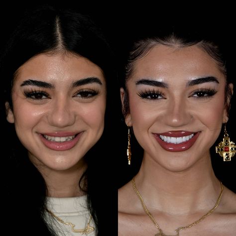 Veneers Before And After, Lumineers Teeth, Cosmetic Bonding, Cosmetic Dentistry Veneers, Botox Before And After, Laser Dentistry, Bone Grafting, Veneers Teeth, Sedation Dentistry