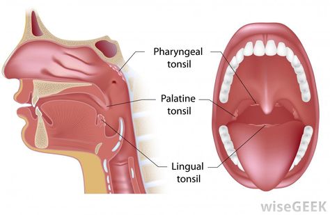 Pharyngeal tonsils (adenoids)  palatine tonsils (tonsillectomy) Lingual Tonsils, Swollen Tonsils, Tonsils And Adenoids, Strep Throat, Bacterial Infection, Respiratory System, Anatomy And Physiology, Home Remedies, Anatomy