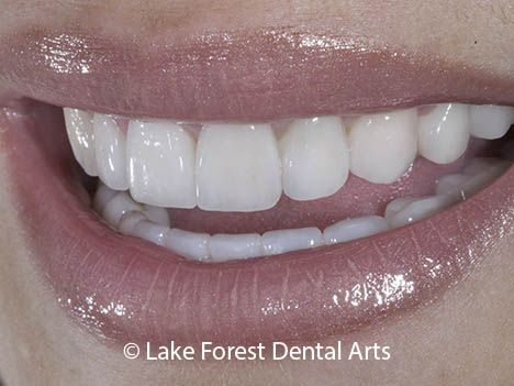 Porcelain Crown Front Teeth, Front Teeth Crowns Before And After, Pretty Teeth Smile, Pretty Crowns, Crown Teeth, Teeth Crown, Prosthetic Teeth, Teeth Aesthetic, Porcelain Crowns