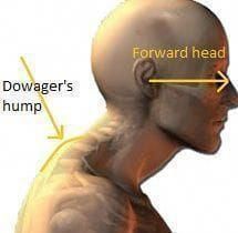 Dowager's Hump, Neck Exercises, Posture Exercises, Simple Exercises, The Bump, Back Exercises, Neck Pain, Head And Neck, Massage Therapy