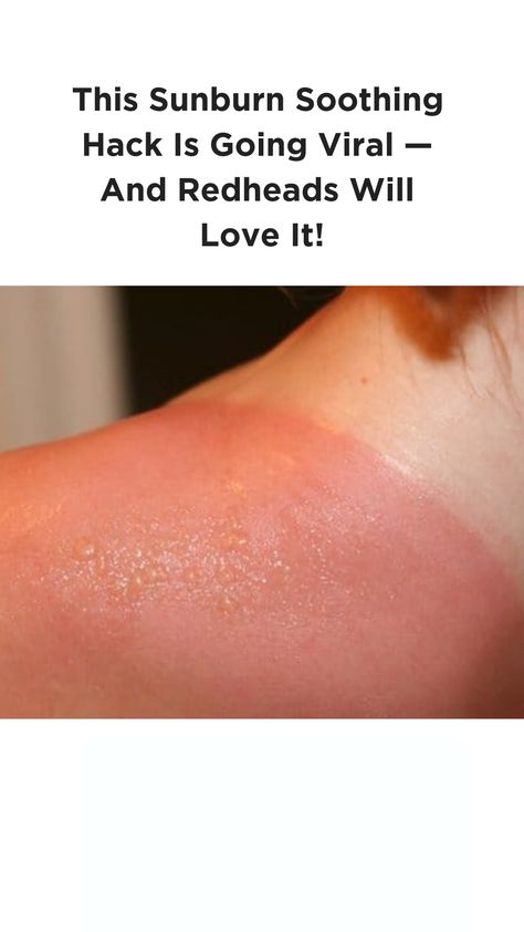 This Sunburn Soothing Hack Is Going Viral — And Redheads Will Love It! Best Sunburn Remedy, Severe Sunburn Relief, Sunburn Relief Instant Diy, Sun Burn Remedy, Sun Blisters, How To Treat Blisters, Sunburn Blisters, How To Help Sunburn, Blister Remedies