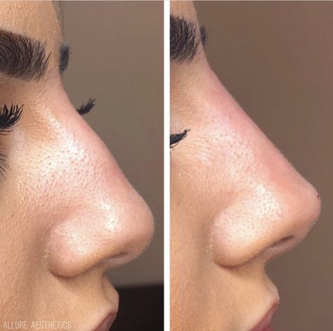 Square Nose, Droopy Nose, Nose Filler, Ethnic Nose Job, Rhinoplasty For Bulbous Nose, Nasal Tip Rhinoplasty, Nosejob Rhinoplasty Before After, Nonsurgical Nose Job, Rhinoplasty Bulbous Nose