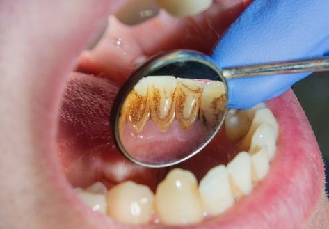 It is a procedure of removing plaque and tartar build up on and around your teeth. Plaque and tartar can form if you allow food particles to remain in between your teeth. Teeth Tartar Removal, Coconut Oil Massage, Tartar Teeth, Tartar Removal, Thames River, Brush Your Teeth, Tooth Enamel, Mosquito Bite, Family Dentistry