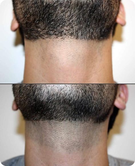 Trim Beard Neckline, Laser Hair Removal Men, Laser Hair Removal Face, Beard Neckline, Hair Remove, Skin Care Business, Laser Removal, Hair Removal For Men, Cosmetic Dermatology