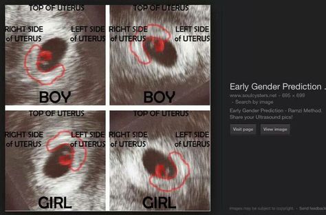 early gender prediction - boy if transvaginal, girl if abdominal (Ramzi theory) Boy Or Girl Prediction Signs, Baby Heart Rate Gender, 7 Weeks Pregnant Ultrasound, Early Gender Prediction, Ultrasound Gender Prediction, Boy Or Girl Prediction, Ramzi Theory, Pregnancy Gender Prediction, Endoscopy Procedure