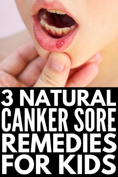 How to Get Rid of Canker Sores | If you and/or your kids are prone to canker sores, and you're looking for canker sore remedies that work fast, this post is for you! Whether you have a canker sore on your lips, cheeks, gums, tongue, or even in your throat (ouch!), this post has tons of useful tips, including information on what causes canker sores, how to prevent canker sores, and quick home remedies for canker sores for toddlers, older kids, and adults. Sore On Tongue Remedy, Natural Canker Sore Remedy, Canker Sore Remedies, Sore In Mouth Remedies, Canker Sore On Tongue, Sore Throat Remedies For Adults, Gum Sores, Canker Sore Remedy, Tongue Sores