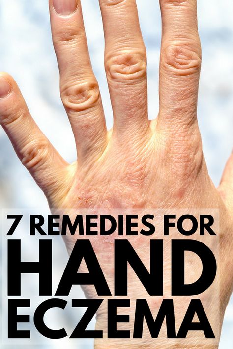 Get Rid Of Warts, Skin Disorders, Itchy Skin, Natural Remedies, Michigan, Lotion, Cream, Skin