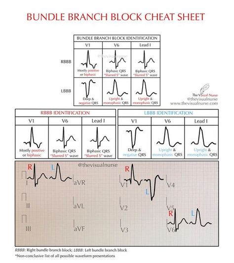 Tyler | The Visual Nurse on Instagram: "Right and left bundle branch block identification cheat sheet. . . Feel free to bookmark and save 👍🏼 . . Follow @thevisualnurse on Instagram for daily rhythm quizzes! . . . #cardiology #cardiacnurse #ekg #futurenurse #nursing #nursingschool #nursingstudent #nursepractitioner #NCLEX #paramedicstudent #RN #FOAMED #residency #exercisescience #nursingeducation #nurseeducator =================== 📱: Instagram @thevisualnurse ⏱: TikTok @the.visualnurse 💻: www Cardiac Pharmacology, Left Bundle Branch Block, Medic School, Emt Study, Bundle Branch Block, Ekg Interpretation, Paramedic School, Daily Rhythm, Nursing School Essential