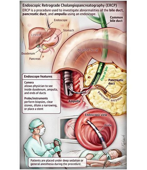 𝐄𝐧𝐝𝐨𝐬𝐜𝐨𝐩𝐢𝐜 𝐫𝐞𝐭𝐫𝐨𝐠𝐫𝐚𝐝𝐞 𝐜𝐡𝐨𝐥𝐚𝐧𝐠𝐢𝐨𝐩𝐚𝐧𝐜𝐫𝐞𝐚𝐭𝐨𝐠𝐫𝐚𝐩𝐡𝐲(𝐄𝐑𝐂𝐏) is performed by gastroenterologists or surgeons to evaluate the bile duct, pancreatic duct, and ampulla... #medizzy #medschool #premed #𝐄𝐧𝐝𝐨𝐬𝐜𝐨𝐩𝐢𝐜 Endoscopy Nursing, Endoscopy Nurse, Medical Procedures, Surgical Nursing, Medical Student Study, Nursing School Survival, Nursing School Studying, Nursing School Tips, Medical School Studying