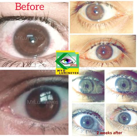 Eye Color Change Surgery, Woman Eyes, Change Your Eye Color, Heart Diet, Laser Eye, Plastic Surgery, Eye Color, You Changed, Blue Eyes