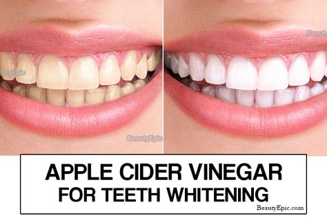 6 Amazing Beauty Benefits of Apple Cider Vinegar Home Remedy For White Teeth, How To Whiten Ur Teeth At Home, Teeth Whitner, Instant Teeth Whitening Diy, Crest Whitening Strips, Apple Cidar Vinegar, Crest Teeth Whitening Light, Reverse Aging Skin, Apple Cider Vinegar Benefits